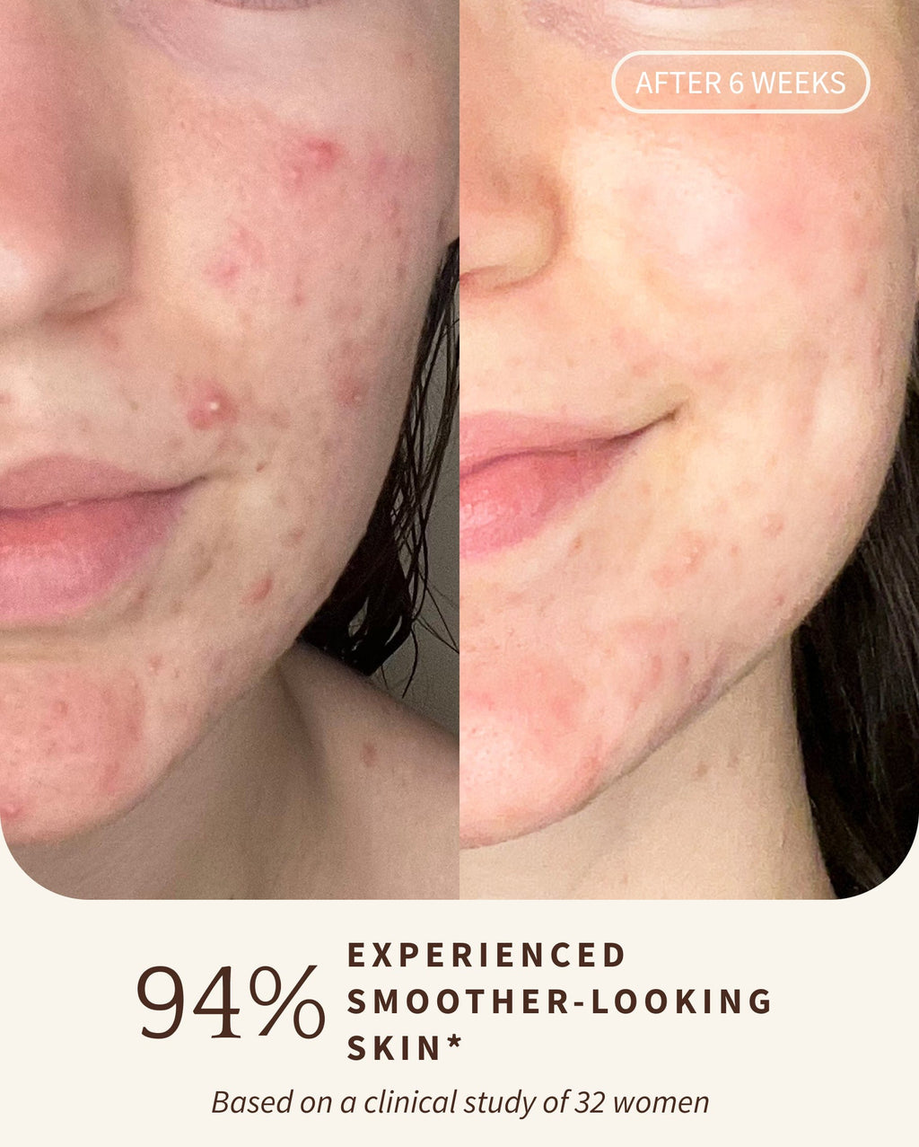 Bambu Earth 3% Bakuchiol Brightening Serum - Before and after comparison of a person's face with acne, showing smoother skin