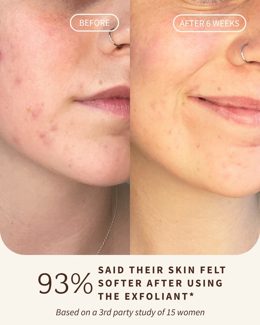 Bambu Earth Bambu + Willow Polishing Mask - Before and after comparison of skin with acne treatment, showing 93% improvement