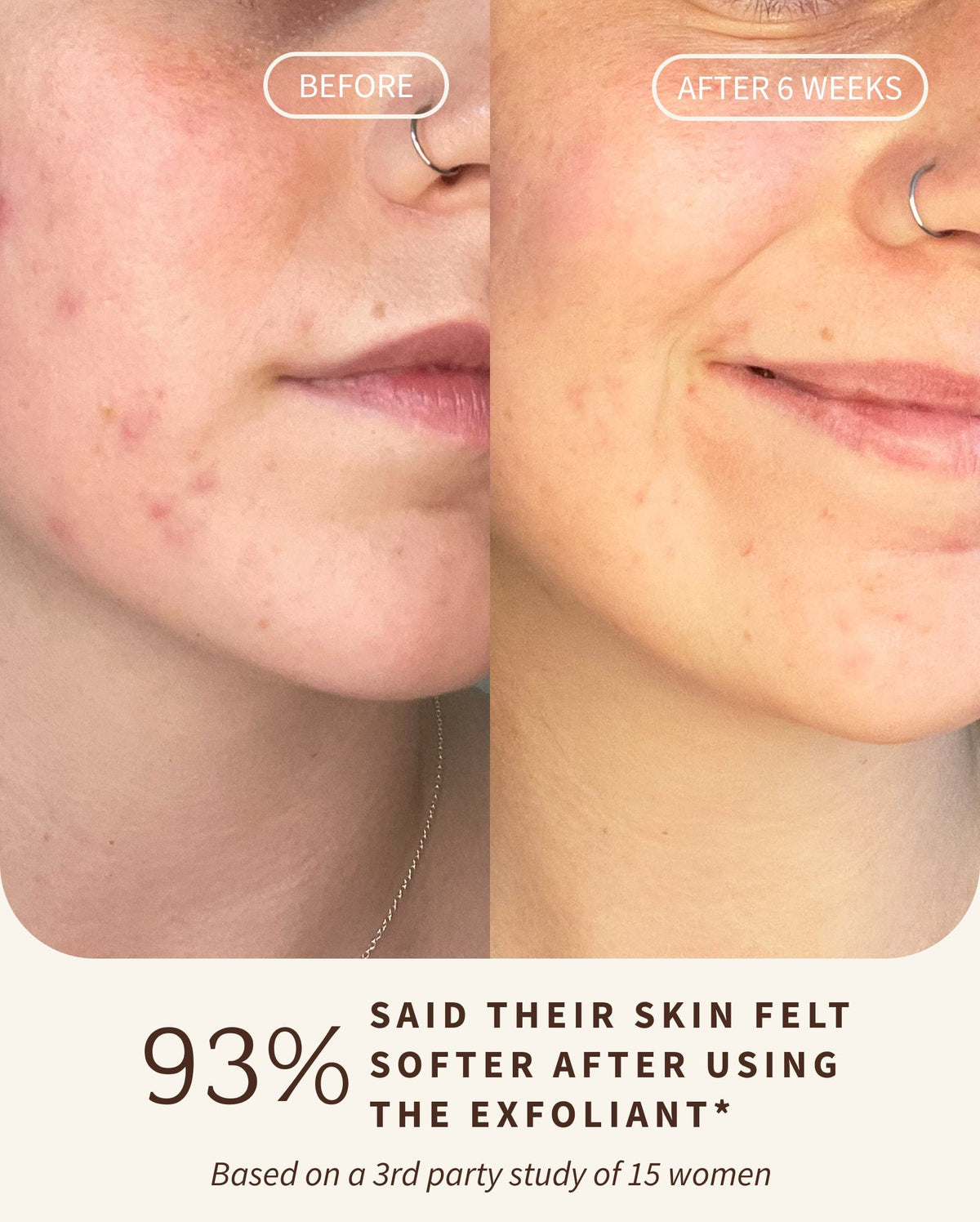 Bambu Earth Bambu + Willow Polishing Mask - Before and after comparison of skin with acne treatment, showing 93% improvement