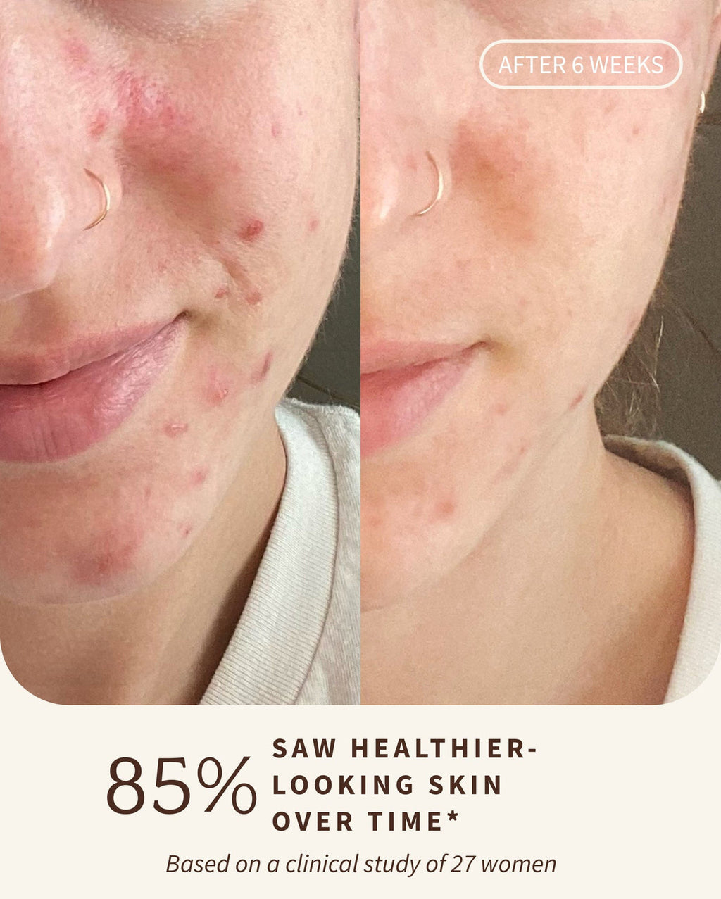 Bambu Earth Rosewater Cleanser - Before and after comparison of skin with acne, showing healthier-looking skin after 6 weeks.