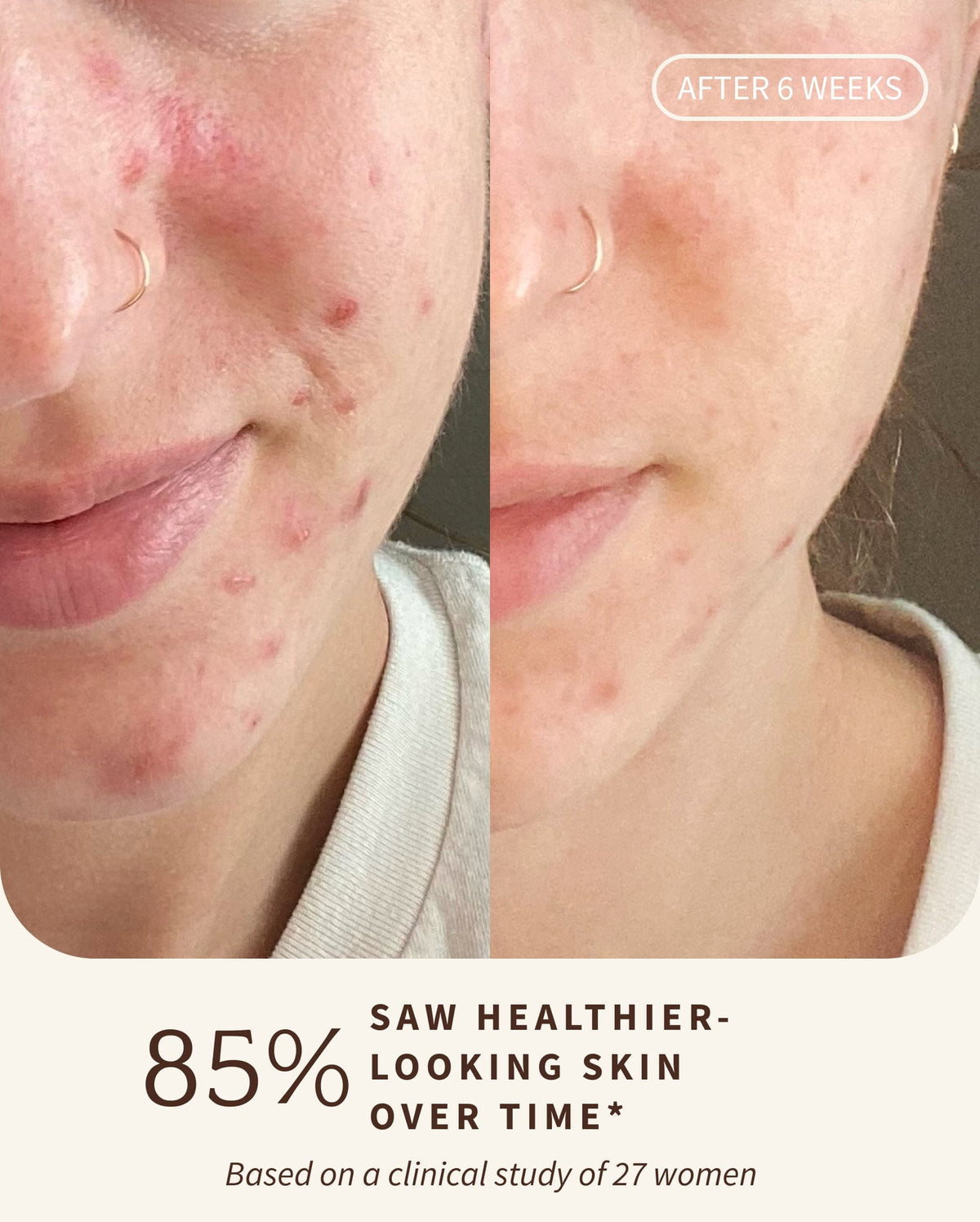 Bambu Earth Rosewater Cleanser - Before and after comparison of skin with acne, showing healthier-looking skin after 6 weeks.